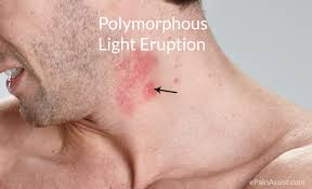 UV POLYMORPOUS LIGHT ERUPTION