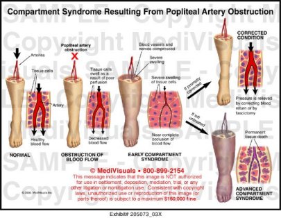 Compartment-Syndrome2