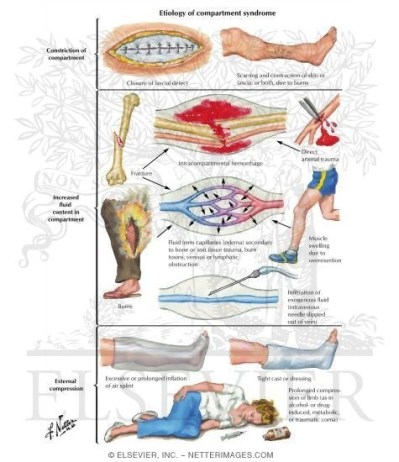 Compartment-Syndrome NGUYÊN NHÂN