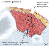 Compartment-Syndrome XẺ GIẢM ÁP FASCIOTOMY