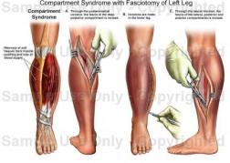 Compartment-Syndrome XẺ GIẢM ÁP FASCIOTOMY2