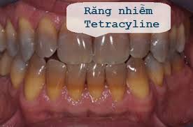 DT 289 (6) răng TETRACYCLINE